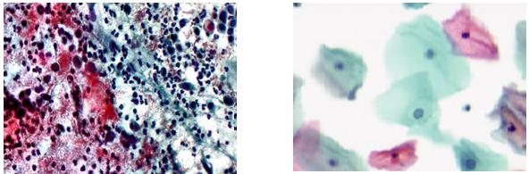 Citologie cervico-vaginală Babeș–Papanicolaou în mediu lichid - Synevo