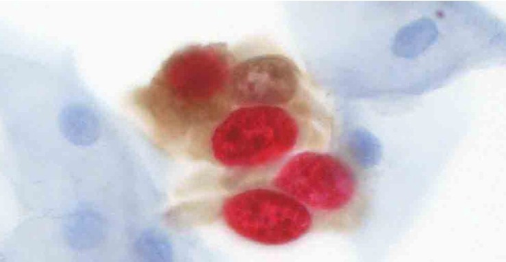 Test Imunocitodiagnostic CIN2+ (CINtec® PLUS) pozitiv