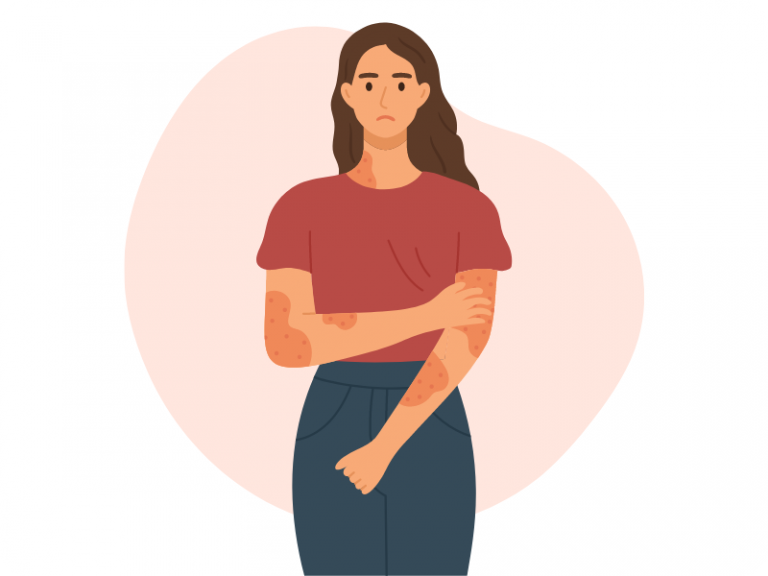 dermatita, ce este dermatita, dermatita atopica, dermatita atopica bebelusi, eczema, eczema piele, dermatita, ce este dermatita