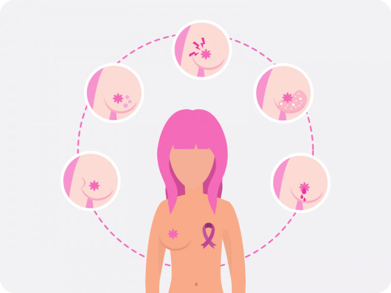 cancer la san, cancer mamar, cancer de san, cancerul de san, cancer de san simptome, simptome cancer san, cancer san simptome, simptome cancer mamar, cancerul de san doare, in cat timp evolueaza cancerul la san, cat de repede avanseaza cancerul la san,