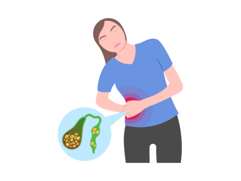 litiaza biliara, pietre la fiere, calculi biliari, litiaza biliara simptome, regim litiaza biliara, operatie litiaza biliara,