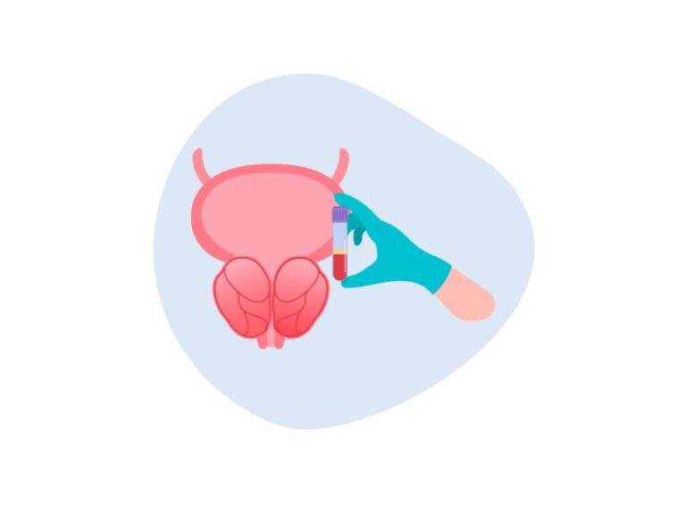 adenom de prostata, prostata, prostata marita, adenomul de prostata, unde doare prostata, prostata, adenom de prostata, ce este adenomul de prostata, adenom de prostata simptome, simptome prostata marita