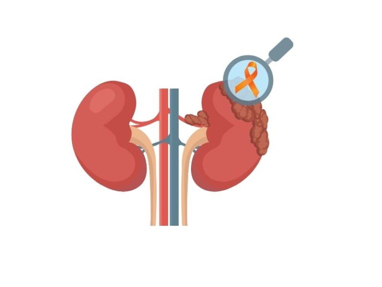 cancer la rinichi, tumoare la rinichi, cancer renal durata de viata, cancer rinichi, cancer renal, cancer la rinichi simptome, tumora rinichi, cancer la rinichi cu metastaze, cancer renal simptome, tumora la rinichi, tumoare rinichi, cancer rinichi simptome, tumora rinichi benigna, cancer de rinichi, cancerul renal, tumora renala, tumoare renala, tumori renale, simptome cancer renal, cancerul de rinichi, simptome rinichi bolnavi, tumora sau chist pe rinichi, biopsie rinichi, chist pe rinichi este grav, chist la rinichi de 3 cm, localizarea rinichilor, cat poti sa traiesti cu dializa, biopsie renala, cancer la rinichi speranta de viata, durata de viata cu un rinichi, simptome probleme rinichi, operatie rinichi clasica